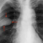 IA revolución en tratamiento del cáncer de pulmón con cirugía de alta precisión 