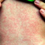 México, en alerta, se dispara el sarampión y ya es el segundo país con más casos en América 
